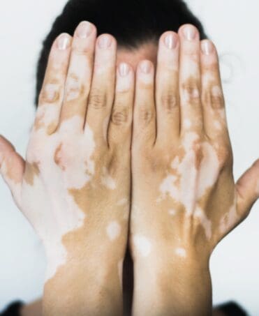 Le vitiligo altère de manière importante la qualité de vie des ...