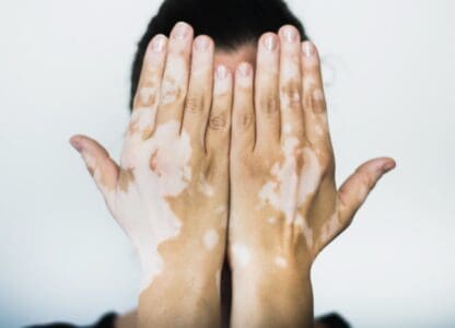 Le vitiligo altère de manière importante la qualité de vie des personnes atteintes